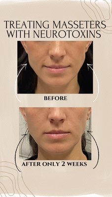 Neurotoxins (wrinkle relaxers) - Botulinum A toxin (which includes Botox, Dysport, Xeomin, and Jeuveau) is used with the intent to temporarily paralyze muscles in order to decrease dynamic wrinkles or lines (those caused by facial movement).
The treatment works on average for 3 months. With treatment over time, wrinkles or lines present at rest are expected to fade or resolve and future wrinkles or lines at rest are prevented. Neurotoxins (wrinkle relaxers) - Botulinum A toxin (which includes Botox, Dysport, Xeomin, and Jeuveau) is used with the intent to temporarily paralyze muscles in order to decrease dynamic wrinkles or lines (those caused by facial movement).
The treatment works on average for 3 months. With treatment over time, wrinkles or lines present at rest are expected to fade or resolve and future wrinkles or lines at rest are prevented.