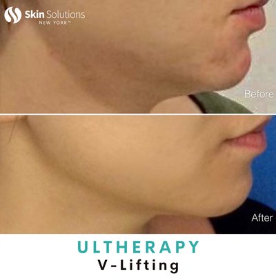 ULTHERAPY Lifting Treatment - Ultherapy is a non-invasive skincare procedure that uses ultrasound to stimulate collagen and elastin production and produce skin lifting and tightening effects without the use of surgery. Ultrasound technology is able to reach the deeper layers of skin compared with laser treatments which will typically target the upper layers. This popular procedure has sometimes been likened to a nonsurgical alternative to a facelift for those who may not feel ready for surgery or are looking to avoid incisions or downtime.

#Ulthera #Ultherapy #AntiAging #SkinSolutionsNY #FlushingMedSpa #FlushingSkinCare