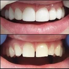 Crystalline, Porcelain veneers and crowns for the optimum health and cosmetics  - We normally examine the patient for head and neck, cancer, and any other potential risks in our screening phase. Then we discussed with the patient their main concerns and we create a treatment plan based on ideal and an alternative for the patients needs.  Crystalline, Porcelain veneers and crowns for the optimum health and cosmetics  - We normally examine the patient for head and neck, cancer, and any other potential risks in our screening phase. Then we discussed with the patient their main concerns and we create a treatment plan based on ideal and an alternative for the patients needs. 