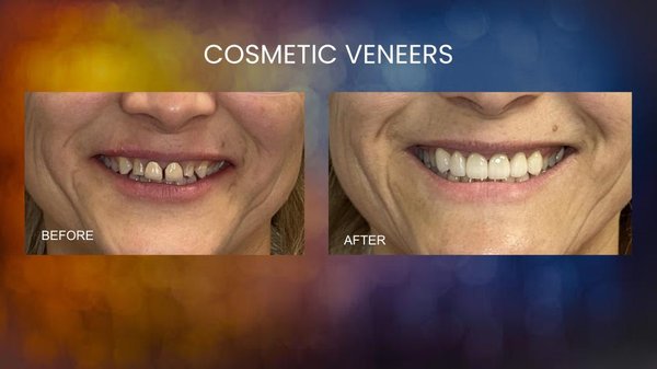 Cosmetic Veneers - Small corrections can have a big impact in your smile!
Call today to schedule a consultation. Cosmetic Veneers - Small corrections can have a big impact in your smile!
Call today to schedule a consultation.
