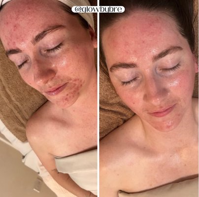 Acne Bootcamp - 3 month Acne Bootcamp transformation with a consistent at-home routine. We used the Green Sea Peel to lift some of that remaining PIE, clear more of her acne, and even out her tone and texture