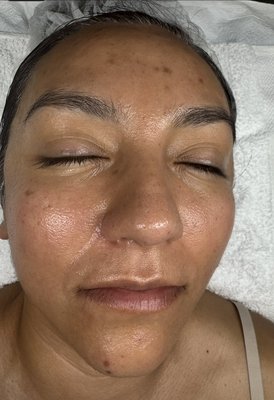 Another acne patient transformation case : combination acne grade 2 , biweekly acne bootcamp - ✨ Acne Transformation Spotlight ✨
This beautiful client started her acne journey with us in April — she came in with Grade 2 acne: closed and open comedones, pustules, and noticeable post-inflammatory hyperpigmentation (PIH).
📅 Fast forward to June — she's cleared! her skin is glowing, healthier, and more balanced than ever!
💪 I’m beyond proud of her progress — not just because of what we did in the treatment room, but because she stayed committed outside the clinic too. She followed her custom acne homecare plan to a T, and the results speak for themselves! 👏
✨ Acne is not your identity — and clear skin is possible.
If you’re struggling with Acne let’s talk. We are the number one acne specialists in Temecula! Book a consultation and let’s get you on the path to healthier, glowing skin 🌿
📍Temecula
Dm @glowaesthetics.clinicalstudio
Text 9517602340
Book online https://glowaestheticsln.glossgenius.com
#TemeculaSkincare #AcneSpecialist #RealResults #GlowWithUs #AcneJourney #SkinTransformation #ClinicalSkincare #GlowAesthetics #AcneHelp #HealthySkinStartsHere Another acne patient transformation case : combination acne grade 2 , biweekly acne bootcamp - ✨ Acne Transformation Spotlight ✨
This beautiful client started her acne journey with us in April — she came in with Grade 2 acne: closed and open comedones, pustules, and noticeable post-inflammatory hyperpigmentation (PIH).
📅 Fast forward to June — she's cleared! her skin is glowing, healthier, and more balanced than ever!
💪 I’m beyond proud of her progress — not just because of what we did in the treatment room, but because she stayed committed outside the clinic too. She followed her custom acne homecare plan to a T, and the results speak for themselves! 👏
✨ Acne is not your identity — and clear skin is possible.
If you’re struggling with Acne let’s talk. We are the number one acne specialists in Temecula! Book a consultation and let’s get you on the path to healthier, glowing skin 🌿
📍Temecula
Dm @glowaesthetics.clinicalstudio
Text 9517602340
Book online https://glowaestheticsln.glossgenius.com
#TemeculaSkincare #AcneSpecialist #RealResults #GlowWithUs #AcneJourney #SkinTransformation #ClinicalSkincare #GlowAesthetics #AcneHelp #HealthySkinStartsHere
