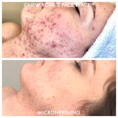 MICRONEEDLING FOR ACNE - MICRONEEDLING FOR ACNE MICRONEEDLING FOR ACNE - MICRONEEDLING FOR ACNE