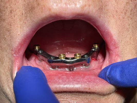 Implant Teeth - Removable for Easy Cleaning But Still Super Secure in Mouth - Having enough implants allows for the option to have teeth which are screwed into place and not removable. But sometimes a client wants something easy to clean. This person wanted something very secure so she can eat anything she wanted but still have the ability to remove them to clean thoroughly. Implant Teeth - Removable for Easy Cleaning But Still Super Secure in Mouth - Having enough implants allows for the option to have teeth which are screwed into place and not removable. But sometimes a client wants something easy to clean. This person wanted something very secure so she can eat anything she wanted but still have the ability to remove them to clean thoroughly.