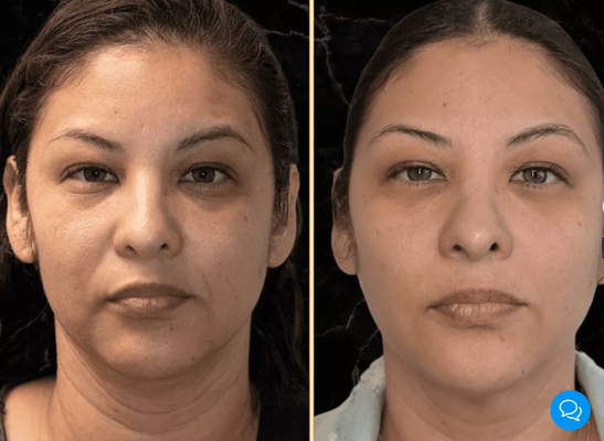 Morpheus8 Face - As people age, their skin often loses its youthful glow and tightness, and wrinkles, discoloration, acne scars, and other imperfections settle in. Those signs of aging can bring down a person’s self-esteem, creating the need for services that restore perfection and beauty to people’s faces and bodies. Morpheus8 is the next evolution of those treatments.
Skin Lab & Contour offers quality Morpheus8 treatment in Danville, CA, that naturally restores your face’s youthful glow, providing lasting results. Here, we’ll look closer at what Morpheus8 is and how you can use it to reshape your image. Morpheus8 Face - As people age, their skin often loses its youthful glow and tightness, and wrinkles, discoloration, acne scars, and other imperfections settle in. Those signs of aging can bring down a person’s self-esteem, creating the need for services that restore perfection and beauty to people’s faces and bodies. Morpheus8 is the next evolution of those treatments.
Skin Lab & Contour offers quality Morpheus8 treatment in Danville, CA, that naturally restores your face’s youthful glow, providing lasting results. Here, we’ll look closer at what Morpheus8 is and how you can use it to reshape your image.