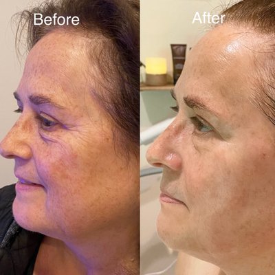 Non-Surgical Facelift Facial - Turn back the clock without surgery with our Non-Surgical Facelift Facial. Using advanced techniques and state-of-the-art technology, this treatment lifts, firms, and tightens the skin for a youthful and contoured appearance. It’s the perfect solution for enhancing your natural beauty without downtime.