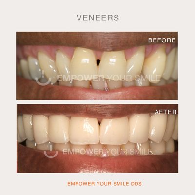invisalign and bonding - Patient with severe diastema in the anterior sector, both upper and lower. It is decided to perform invisalign treatment. Once the correct location of the dental elements and closure of spaces, we proceed with veneers to improve shape and color. invisalign and bonding - Patient with severe diastema in the anterior sector, both upper and lower. It is decided to perform invisalign treatment. Once the correct location of the dental elements and closure of spaces, we proceed with veneers to improve shape and color.