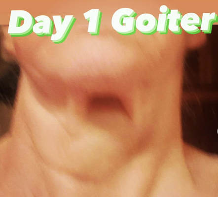 Goiters are reversible, no surgery or drugs needed - Woman client suffering a goiter for many years. Doctors wanted to surgically remove it. Call to speak to our office today. 844-275-1056. Goiters are reversible, no surgery or drugs needed - Woman client suffering a goiter for many years. Doctors wanted to surgically remove it. Call to speak to our office today. 844-275-1056.