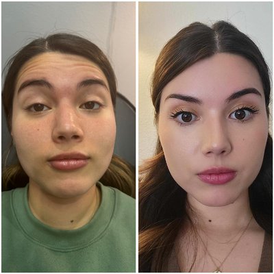 Botox - These are before and after of neurotoxins Botox - These are before and after of neurotoxins