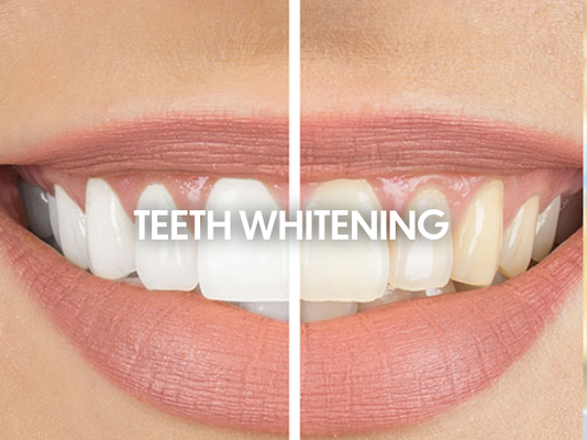 Teeth Whitening - Teeth get stained over time by foods and drinks.  Think coffee, tea, red wine, beets – how much would they stain a white t-shirt?  Whitening uses a peroxide to clean those stains from the surface of the teeth.  We use KOR whitening in our office.  We prefer Kor because it starts with home treatments, and then finishes with in-office whitening and provides the best results.  We recommend a white diet after bleaching for 48 hours.  A list of non-staining foods will be given to you.  Whitening has no known long-term negative effects, but can result in some short-term sensitivity during treatment that will go away after your treatment is completed.