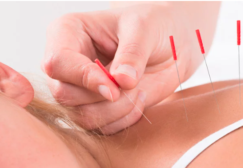 WE OFFER ACUPUNCTURE! - We are pleased to now offer acupuncture therapy at our clinic in Palos Heights. Any kind of chronic pain from sciatica, arthritis a pinched nerve, or many other disorders can be upsetting. Treating nerve pain with traditional medicine is difficult as often nerve pain does not respond to prescription pain relief including narcotics. Acupuncture is accepted as a viable form of healthcare treatment. Our team is here to help.

HOW DOES ACUPUNCTURE WORK?
With all the toxins present in our various environments, it is important that our bodies are well suited to interact and deal with each challenge that we face. While traditional and western explanations of acupuncture vary, each fundamentally deals with acclimating our body to our surroundings. After thousands of years of research, various points across the body have been located that have a significant impact on our body's overall physiology. Typically, depending on the desired end result, fine needles are meticulously positioned at these points to stimulate various aspects of our hormonal, immune, and endocrine systems. Once these systems have been stimulated, a number of neurotransmitters, natural pain killers, and hormones are released. Patients at our Hauser Chiropractic Care have described the following effects following acupuncture treatments:

Decreases in muscles spasms and pain
Decrease in swelling at various points across the body
A general decrease in pain
A decrease in illnesses due to stimulation of the immune system
Lower levels of back and neck pain
Fewer headaches
Improved digestion
Overall better sleep
Fewer injuries during recreational sports
Females report less gynecological issues