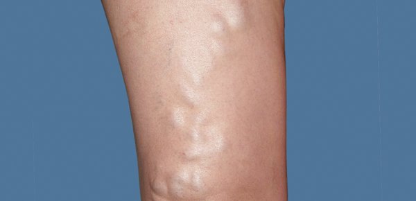 Microphlebectomy of Varicose Veins - Microphlebectomy is a treatment in which we remove the diseased vein through tiny pinpoint incisions. The "after" photo is approximately one month after treatment. The minimal scarring will fade to small white marks which are virtually invisible. This procedure is done painlessly with local anesthesia in our office. Call 714-955-5960 for details! Microphlebectomy of Varicose Veins - Microphlebectomy is a treatment in which we remove the diseased vein through tiny pinpoint incisions. The "after" photo is approximately one month after treatment. The minimal scarring will fade to small white marks which are virtually invisible. This procedure is done painlessly with local anesthesia in our office. Call 714-955-5960 for details!