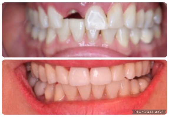Replace a Missing Tooth with a Single Dental Implant - Losing a tooth affects more than just your smile. A missing tooth can make chewing more difficult, alter your bite, cause neighboring teeth to shift, and lead to gradual bone loss in the jaw. A single dental implant is one of the most predictable and long-lasting ways to replace a missing tooth while preserving your oral health.
At Russell Dental, we restore missing teeth with dental implants that are designed to look, feel, and function like natural teeth. Unlike a traditional bridge, a single implant replaces the tooth without requiring the healthy teeth next to it to be reshaped. The implant is placed into the jawbone, where it fuses with the bone over time, creating a stable foundation for a custom-made crown.
Benefits of a Single Dental Implant
✔ Restores your smile with a natural appearance
✔ Functions like a natural tooth for comfortable chewing and speaking
✔ Helps preserve jawbone and reduce bone loss after tooth loss
✔ Prevents neighboring teeth from shifting
✔ Maintains proper bite alignment
✔ Does not require altering healthy adjacent teeth
✔ Supports long-term oral health and function
✔ Designed to be durable and long-lasting with proper care
Why Replacing a Missing Tooth Matters
Even one missing tooth can have lasting effects on your oral health. Over time, the surrounding teeth may drift into the empty space, changing your bite and making teeth more difficult to clean. This can increase the risk of cavities, gum disease, uneven tooth wear, and jaw discomfort. Because the jawbone no longer receives stimulation where the tooth is missing, the bone can gradually shrink, affecting both facial appearance and future treatment options.
Replacing a missing tooth with a dental implant helps maintain the health, stability, and function of your entire smile—not just the appearance.
At Russell Dental, we use advanced technology and personalized treatment planning to ensure every implant is designed to meet your individual needs. Whether you've recently lost a tooth or have been missing one for years, we'll help determine if a dental implant is the right solution for you.
A complete smile isn't just about aesthetics—it's about protecting your long-term oral health, preserving your jawbone, and restoring the confidence to eat, speak, and smile comfortably.
Not every patient is an immediate candidate for dental implants. A comprehensive examination, digital imaging, and evaluation of your oral health are required to determine the best treatment plan. Replace a Missing Tooth with a Single Dental Implant - Losing a tooth affects more than just your smile. A missing tooth can make chewing more difficult, alter your bite, cause neighboring teeth to shift, and lead to gradual bone loss in the jaw. A single dental implant is one of the most predictable and long-lasting ways to replace a missing tooth while preserving your oral health.
At Russell Dental, we restore missing teeth with dental implants that are designed to look, feel, and function like natural teeth. Unlike a traditional bridge, a single implant replaces the tooth without requiring the healthy teeth next to it to be reshaped. The implant is placed into the jawbone, where it fuses with the bone over time, creating a stable foundation for a custom-made crown.
Benefits of a Single Dental Implant
✔ Restores your smile with a natural appearance
✔ Functions like a natural tooth for comfortable chewing and speaking
✔ Helps preserve jawbone and reduce bone loss after tooth loss
✔ Prevents neighboring teeth from shifting
✔ Maintains proper bite alignment
✔ Does not require altering healthy adjacent teeth
✔ Supports long-term oral health and function
✔ Designed to be durable and long-lasting with proper care
Why Replacing a Missing Tooth Matters
Even one missing tooth can have lasting effects on your oral health. Over time, the surrounding teeth may drift into the empty space, changing your bite and making teeth more difficult to clean. This can increase the risk of cavities, gum disease, uneven tooth wear, and jaw discomfort. Because the jawbone no longer receives stimulation where the tooth is missing, the bone can gradually shrink, affecting both facial appearance and future treatment options.
Replacing a missing tooth with a dental implant helps maintain the health, stability, and function of your entire smile—not just the appearance.
At Russell Dental, we use advanced technology and personalized treatment planning to ensure every implant is designed to meet your individual needs. Whether you've recently lost a tooth or have been missing one for years, we'll help determine if a dental implant is the right solution for you.
A complete smile isn't just about aesthetics—it's about protecting your long-term oral health, preserving your jawbone, and restoring the confidence to eat, speak, and smile comfortably.
Not every patient is an immediate candidate for dental implants. A comprehensive examination, digital imaging, and evaluation of your oral health are required to determine the best treatment plan.
