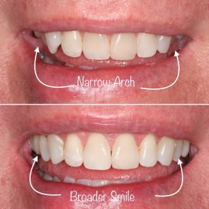 Invisalign Before & After Cases from Dr. Jon Asimakopoulos - These are a few of the patient cases completed by Dr. Jon Asimakopoulos at Schaumburg Dentistry using Invisalign treatment. Check out our website to see even more amazing cases and call us to schedule your own free consultation! Invisalign Before & After Cases from Dr. Jon Asimakopoulos - These are a few of the patient cases completed by Dr. Jon Asimakopoulos at Schaumburg Dentistry using Invisalign treatment. Check out our website to see even more amazing cases and call us to schedule your own free consultation!