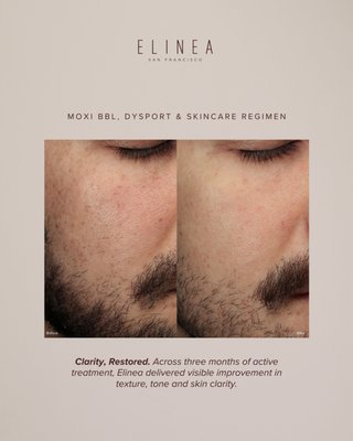 TEXTURE, TONE & DYSCHROMIA - Elinea providers designed a tailored protocol combining MOXI BBL and Dysport with a custom skincare regimen, delivered across three sessions for optimal results.
