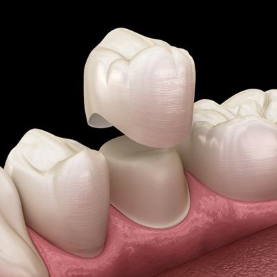 What Is a Dental Crown? - Am I a Good Candidate for a Dental Crown?
Crowns are quite versatile and can be used in a variety of situations, such as when a tooth has:
Suffered extreme decay that can’t be treated with a filling alone
Been severely injured and essentially needs to be rebuilt
Become weakened and has a high risk of fracturing in the future
A cosmetic flaw like a crack or chip
Been lost and a dental implant needs to be covered
Been recently treated with root canal therapy What Is a Dental Crown? - Am I a Good Candidate for a Dental Crown?
Crowns are quite versatile and can be used in a variety of situations, such as when a tooth has:
Suffered extreme decay that can’t be treated with a filling alone
Been severely injured and essentially needs to be rebuilt
Become weakened and has a high risk of fracturing in the future
A cosmetic flaw like a crack or chip
Been lost and a dental implant needs to be covered
Been recently treated with root canal therapy