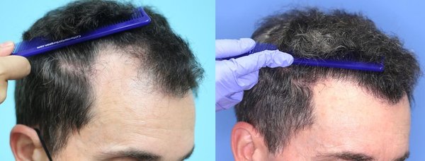 Hair Transplant Case Studies - These patients had hair transplant surgery to restore their hairline and self-confidence. Visit our website to read about these and other happy experiences. Hair Transplant Case Studies - These patients had hair transplant surgery to restore their hairline and self-confidence. Visit our website to read about these and other happy experiences.