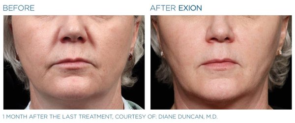 Exion RF Microneedling and RF Ultrasound - The results of our Exion RF Microneedling and RF Ultrasound are amazing! Call for your free consultation. Packages and memberships are available. Exion RF Microneedling and RF Ultrasound - The results of our Exion RF Microneedling and RF Ultrasound are amazing! Call for your free consultation. Packages and memberships are available.