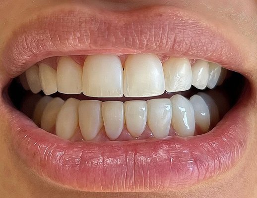 Cosmetic Treatment - Cosmetic treatment services we offer here at Westminster Dental Plaza:
-Cosmetic Bonding
-In-house Bleaching
-At-home Bleaching
-Crowns
-Veneers