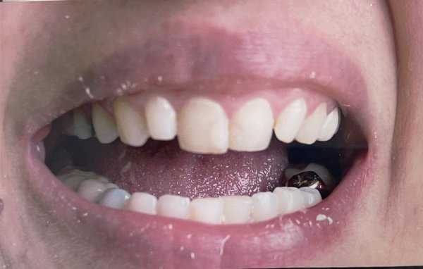 Anterior makeover - This patient was unhappy with her smile and anterior teeth. The front four teeth were upgraded with crowns and veneers to produce a beautiful smile. Anterior makeover - This patient was unhappy with her smile and anterior teeth. The front four teeth were upgraded with crowns and veneers to produce a beautiful smile.