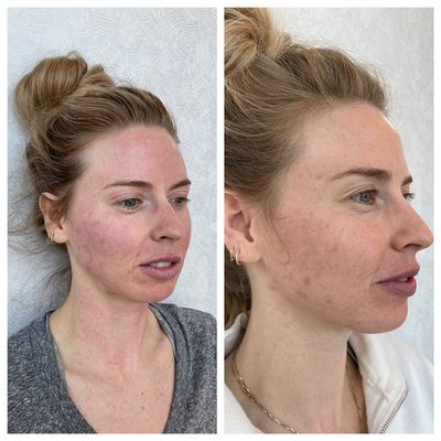 Acne treatment with am Agnes and skin tightening with Scarlet SRF. 1 week after, next treatment in 3 weeks. - Agnes RF with Scarlet SRF Acne treatment with am Agnes and skin tightening with Scarlet SRF. 1 week after, next treatment in 3 weeks. - Agnes RF with Scarlet SRF