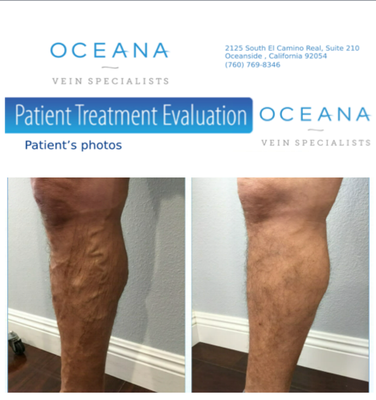 Varicose Vein Before/After - 54 year old male who presented with painful bulging varicose veins. Patient had prior history of deep vein thrombosis and several treatments at outside vein center, without resolution. Dr. Adam Isadore performed an endovenous radiofrequency ablation of the right great saphenous vein followed by 2 rounds of large vein foam sclerotherapy. Phlebectomy was not an option in this patient due to patient being on blood thinning medication for prior deep vein thrombosis. Post procedures photos demonstrates near complete resolution of bulging varicose veins.