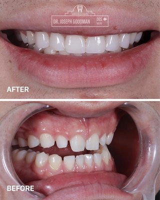 porcelain veneers. Final results are better than they Appear in photos - porcelain veneers crafted by Joseph Goodman DDS porcelain veneers. Final results are better than they Appear in photos - porcelain veneers crafted by Joseph Goodman DDS