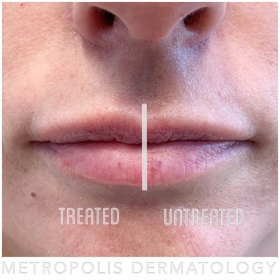 Lip Injections - Creating or re-creating naturally shaped lips is an art. We carefully select customized filler to create the lips our patients want without going overboard. Lip Injections - Creating or re-creating naturally shaped lips is an art. We carefully select customized filler to create the lips our patients want without going overboard.