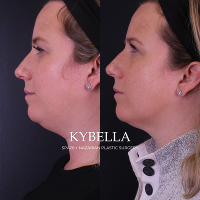 Kybella: Before & After - Kybella is a non-surgical, non-invasive injection treatment that works to eliminate unwanted fat. Kybella permanently reduces submental fat under the chin and in body areas, such as the outer thighs, mons pubis, bra fat, or knees.

As you are undoubtedly informed, fat accumulates due to aging, weight gain, or genetics. Surgical treatments, such as facelifts, neck lifts, and liposuction, used to be the only solutions for removing fat beneath the chin and other body areas. Well, chin up because we now have Kybella™ — the revolutionary non-surgical treatment that permanently melts undesirable fat!

Plastic surgeon near me
Kybella in LA
Kybella in Beverly Hills
Plastic surgeons that offer financing
Women Plastic Surgeon
Plastic Surgeon in Beverly Hills
Netflix Surgeon
Women Owned