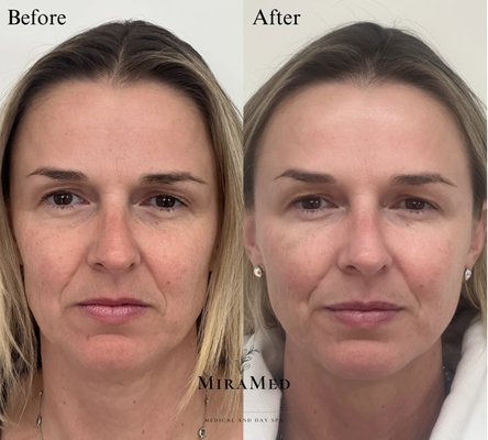 Full Face Rejuvenation - This patient received filler in her undereye area, midface, and lips. She also received 50 units of Botox/Jeuveau in her forehead lines, frown lines, and crow's feet. She looks 10 years younger thanks to Nurse Elaine! Full Face Rejuvenation - This patient received filler in her undereye area, midface, and lips. She also received 50 units of Botox/Jeuveau in her forehead lines, frown lines, and crow's feet. She looks 10 years younger thanks to Nurse Elaine!