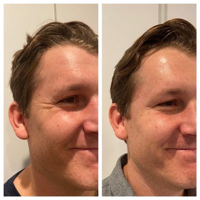 Botox - Smooth the skin while giving your face (and neck!) an over all refreshed and lifted appearance! Enjoy new patients introductory pricing! Botox - Smooth the skin while giving your face (and neck!) an over all refreshed and lifted appearance! Enjoy new patients introductory pricing!