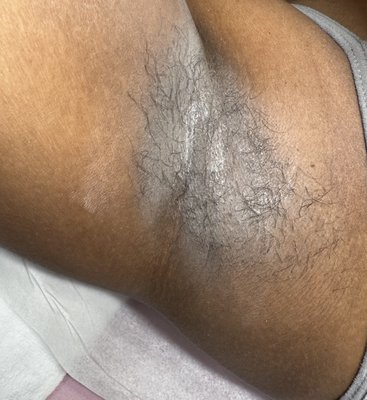 Underarm Wax - This service was completed on my regular client. She attends her appointment every 4 weeks. To remove her hair I utilize pre wax products, powder and hard wax and I also add oil afterward to help remove any left over wax. Finally I finish with a post wax solution to ensure she has a slower hair growth and no ingrown hairs. Underarm Wax - This service was completed on my regular client. She attends her appointment every 4 weeks. To remove her hair I utilize pre wax products, powder and hard wax and I also add oil afterward to help remove any left over wax. Finally I finish with a post wax solution to ensure she has a slower hair growth and no ingrown hairs.