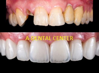 Dental Implants - Dental implants are a popular and effective solution for replacing missing teeth. They are a long-term, durable, and natural-looking option that offers several advantages for individuals with missing teeth. Here are the key aspects of dental implants:

    Implant Structure: A dental implant consists of three main parts:

        Implant Fixture: This is a small, screw-like post typically made of biocompatible titanium. It is surgically placed into the jawbone and acts as an artificial tooth root.

        Abutment: The abutment is a connector that attaches to the implant fixture and protrudes above the gumline. It serves as a support for the replacement tooth (crown, bridge, or denture).

        Prosthetic Tooth: The prosthetic tooth (crown, bridge, or denture) is custom-made to match the appearance and function of natural teeth and is attached to the abutment.

    Process:

        Consultation: The process begins with a consultation with Dr Elzayat to assess your oral health, discuss treatment options, and create a personalized treatment plan.

        Implant Placement: During the surgical procedure, the implant fixture is placed into the jawbone, where it fuses with the bone in a process called osseointegration. This provides a stable foundation for the replacement tooth.

        Healing: The healing process and osseointegration may take several months, during which temporary restorations can be used; especially for anterior teeth.

        Abutment Placement: Once the implant has integrated with the bone, the abutment is attached to the implant fixture.

        Prosthetic Attachment: Finally, a custom-made prosthetic tooth is securely attached to the abutment, completing the dental implant restoration.

    Advantages:

        Natural Appearance: Dental implants closely resemble natural teeth in both appearance and function, providing a highly aesthetic and realistic result.

        Durability: Implants are a long-lasting solution, often lasting a lifetime with proper care and maintenance.

        Stability and Function: Dental implants provide a stable and strong bite, allowing you to eat, speak, and chew with confidence.

        Preservation of Bone Health: Implants stimulate the jawbone, helping to prevent bone loss that commonly occurs after tooth loss.

        No Impact on Adjacent Teeth: Unlike traditional bridges, dental implants do not require the alteration of neighboring healthy teeth for support.

    Suitability: Dental implants are suitable for many individuals, but a patient's overall health, bone density, and oral hygiene play a role in determining candidacy. In some cases, bone grafting or other preparatory procedures may be necessary to ensure a successful implant placement.

Dental implants have become a widely accepted and successful solution for replacing missing teeth, offering numerous benefits and a high degree of patient satisfaction. 

Call or Schedule a Consultation Online with Dr Elzayat.
