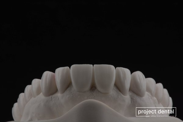 Diagnostic Waxup - Full-mouth reconstruction can be a recommended treatment for patients who need multiple dental issues addressed or need all of their teeth either repaired or replaced. Before we star the treatment, we carefully analyze the patient's current condition and perform diagnostic design. Diagnostic Waxup - Full-mouth reconstruction can be a recommended treatment for patients who need multiple dental issues addressed or need all of their teeth either repaired or replaced. Before we star the treatment, we carefully analyze the patient's current condition and perform diagnostic design.