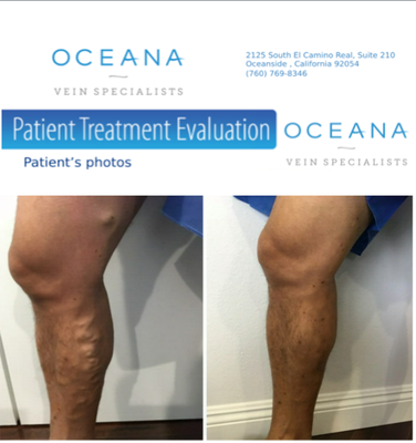 Varicose Vein Before/After - 49 year old male presenting with painful bulging varicose veins. Dr. Adam Isadore performed an endovenous radiofrequency ablation of the right great saphenous vein followed with a phlebectomy of the bulging varicose vein tributaries.