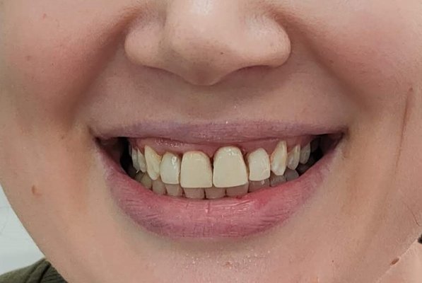 Smile Makeover - Many times we see patients that have existing work from other dental offices. We one goal in mind with each patient. To give them a smile they will love!