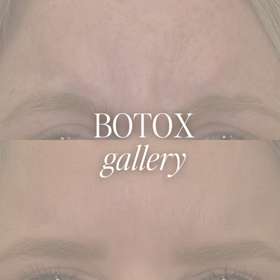 Botox - At The Aesthetic Suite, we provide neuromodulator treatments designed to smooth lines and refine facial contours while maintaining a natural appearance. We offer trusted brands including Xeomin and Dysport, with treatments tailored to deliver subtle, refreshed results that never look overdone. Our expertise lies in achieving balance and harmony while preserving natural expression. Commonly treated areas include the forehead, masseter, neck, and eyes. Each treatment is customized to the individual, helping patients look rested, youthful, and confident. Botox - At The Aesthetic Suite, we provide neuromodulator treatments designed to smooth lines and refine facial contours while maintaining a natural appearance. We offer trusted brands including Xeomin and Dysport, with treatments tailored to deliver subtle, refreshed results that never look overdone. Our expertise lies in achieving balance and harmony while preserving natural expression. Commonly treated areas include the forehead, masseter, neck, and eyes. Each treatment is customized to the individual, helping patients look rested, youthful, and confident.