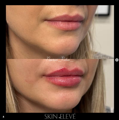 Lip Filler Treatments at Skin Elevé - At Skin Elevé, we offer expertly performed lip filler treatments to help you achieve fuller, more defined, and naturally beautiful lips. Whether you’re looking to subtly enhance volume, restore youthful shape, or refine lip symmetry, our experienced injectors customize each treatment to suit your unique features and aesthetic goals.
What Are Lip Fillers?
Lip fillers are injectable treatments made with hyaluronic acid (HA) — a naturally occurring substance in the body that helps retain moisture and add volume. We use only FDA-approved, high-quality dermal fillers that are trusted for their safety, softness, and long-lasting, natural-looking results.
What Lip Filler Can Do:
Add volume and fullness
Define the lip border (vermillion border)
Enhance the cupid’s bow
Improve symmetry between top and bottom lips
Smooth out fine lines around the mouth (perioral lines)
The Skin Elevé Approach
We believe in elevated, natural beauty—never overdone. Our goal is to enhance your lips in a way that complements your facial proportions and personal style. Whether you're a first-timer or looking to refine previous work, we take the time to understand your vision and guide you through a comfortable, customized experience.
What to Expect:
Results are visible immediately with minimal downtime
Mild swelling or bruising may occur and typically resolves within a few days
Results last 6–12 months, depending on the product used and your individual metabolism
We are located in Chatsworth, Los Angeles, CA Lip Filler Treatments at Skin Elevé - At Skin Elevé, we offer expertly performed lip filler treatments to help you achieve fuller, more defined, and naturally beautiful lips. Whether you’re looking to subtly enhance volume, restore youthful shape, or refine lip symmetry, our experienced injectors customize each treatment to suit your unique features and aesthetic goals.
What Are Lip Fillers?
Lip fillers are injectable treatments made with hyaluronic acid (HA) — a naturally occurring substance in the body that helps retain moisture and add volume. We use only FDA-approved, high-quality dermal fillers that are trusted for their safety, softness, and long-lasting, natural-looking results.
What Lip Filler Can Do:
Add volume and fullness
Define the lip border (vermillion border)
Enhance the cupid’s bow
Improve symmetry between top and bottom lips
Smooth out fine lines around the mouth (perioral lines)
The Skin Elevé Approach
We believe in elevated, natural beauty—never overdone. Our goal is to enhance your lips in a way that complements your facial proportions and personal style. Whether you're a first-timer or looking to refine previous work, we take the time to understand your vision and guide you through a comfortable, customized experience.
What to Expect:
Results are visible immediately with minimal downtime
Mild swelling or bruising may occur and typically resolves within a few days
Results last 6–12 months, depending on the product used and your individual metabolism
We are located in Chatsworth, Los Angeles, CA