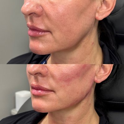 PDO threads - A non-surgical face and neck lift uses advanced PDO threads to reposition and tighten skin without the need for invasive surgery. This is a minimally invasive procedure with no incisions or scarring, quick recovery time, natural-looking results, and customizable treatment plans. PDO threads - A non-surgical face and neck lift uses advanced PDO threads to reposition and tighten skin without the need for invasive surgery. This is a minimally invasive procedure with no incisions or scarring, quick recovery time, natural-looking results, and customizable treatment plans.