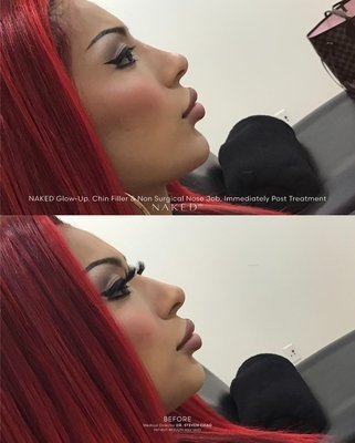 Naked Nose - Non-surgical Nose Job - Ideal for people who are looking to smooth out bumps on their nose, enhance their bridge, lift or add structure to the tip. Although a NSNJ may change the appearance anteriorly, it mainly affects the lateral or “side” profile. When HA filler is placed properly, it may give the illusion of a smaller and thinner nose. A NSNJ does not remove volume from the nose or shorten it. Naked Nose - Non-surgical Nose Job - Ideal for people who are looking to smooth out bumps on their nose, enhance their bridge, lift or add structure to the tip. Although a NSNJ may change the appearance anteriorly, it mainly affects the lateral or “side” profile. When HA filler is placed properly, it may give the illusion of a smaller and thinner nose. A NSNJ does not remove volume from the nose or shorten it.