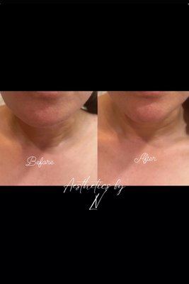 Fillers done by Lauren! - Add filler to help create symmetry, contour & slimmer facial features! Fillers done by Lauren! - Add filler to help create symmetry, contour & slimmer facial features!