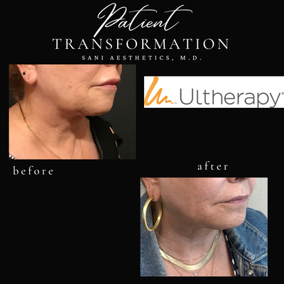 Ultherapy - Ultherapy is a non-invasive treatment, goes deeper to stimulate production of your body’s own collagen and elastin, for natural-looking results without surgery or downtime. Ultherapy is the only FDA-cleared, non-invasive procedure that lifts the neck, chin and brow, and improves lines and wrinkles on the upper chest. Ultherapy relies on ultrasound therapy to go deeper than other non-invasive treatments for collagen stimulation. And it leverages traditional ultrasound imaging so Ultherapy providers can see the layers of tissue they are treating. This ensures the treatment energy is delivered to where it benefits you most. Ultherapy - Ultherapy is a non-invasive treatment, goes deeper to stimulate production of your body’s own collagen and elastin, for natural-looking results without surgery or downtime. Ultherapy is the only FDA-cleared, non-invasive procedure that lifts the neck, chin and brow, and improves lines and wrinkles on the upper chest. Ultherapy relies on ultrasound therapy to go deeper than other non-invasive treatments for collagen stimulation. And it leverages traditional ultrasound imaging so Ultherapy providers can see the layers of tissue they are treating. This ensures the treatment energy is delivered to where it benefits you most.