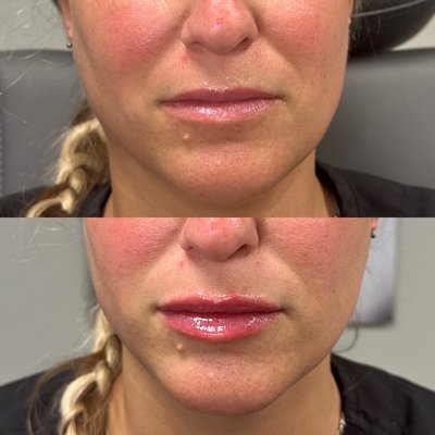 Fillers - Dermal fillers involve injecting a gel-like substance to replenish lost volume, soften wrinkles, and enhance facial contours. Most fillers use hyaluronic acid, a naturally occurring substance in the body that keeps skin hydrated, soft, and firm. By restoring hyaluronic acid , dermal fillers provide immediate improvements with long-lasting results. Fillers - Dermal fillers involve injecting a gel-like substance to replenish lost volume, soften wrinkles, and enhance facial contours. Most fillers use hyaluronic acid, a naturally occurring substance in the body that keeps skin hydrated, soft, and firm. By restoring hyaluronic acid , dermal fillers provide immediate improvements with long-lasting results.