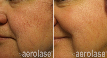 Aerolase Laser Treatment - These are a variety of before and after photos to give an idea of what indications our laser treatment can help with.