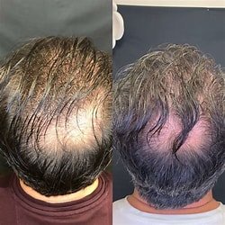 PRP Hair Restoration - This platelet-rich plasma is then precisely injected into areas of hair loss on the scalp.
The platelets contain growth factors that act as cell signaling tools to wake up dormant follicles and improve blood circulation. This creates a revitalized microenvironment to prevent further hair loss and promote new growth.
Recovery: There is minimal downtime required after PRP injections. Some patients report mild swelling or tightness in the treatment area for a day or two. Most return to normal activity immediately.
Results: PRP delivers essential nutrients to the follicles needed for healthy hair production. Over a series of treatments, patients see a reduction in hair loss combined with increased thickness and density. Results are gradual over a period of months as hair growth cycles renew.
Good Candidates: Both men and women experiencing thinning hair or balding who want a non-surgical option for hair restoration. PRP is safe for all hair types and works well in the early to moderate stages of hair loss. PRP Hair Restoration - This platelet-rich plasma is then precisely injected into areas of hair loss on the scalp.
The platelets contain growth factors that act as cell signaling tools to wake up dormant follicles and improve blood circulation. This creates a revitalized microenvironment to prevent further hair loss and promote new growth.
Recovery: There is minimal downtime required after PRP injections. Some patients report mild swelling or tightness in the treatment area for a day or two. Most return to normal activity immediately.
Results: PRP delivers essential nutrients to the follicles needed for healthy hair production. Over a series of treatments, patients see a reduction in hair loss combined with increased thickness and density. Results are gradual over a period of months as hair growth cycles renew.
Good Candidates: Both men and women experiencing thinning hair or balding who want a non-surgical option for hair restoration. PRP is safe for all hair types and works well in the early to moderate stages of hair loss.