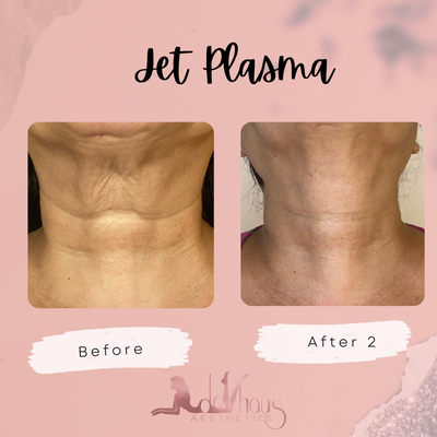 Jet Plasma - What is Jet Plasma?
Jet Plasma is state-of-the-art technology that’s used for skin tightening and non-surgical skin lifting. It is used for non-surgical tightening skin on the neck and around the mouth, hand rejuvenation as well. Unlike many of the other plasma devices on the market, the Jet Plasma pen uses a direct current (DC) rather than an alternating current (AC) which allows it ‘scan’ the skin. This means it is more versatile, can be used over larger areas without creating as much damage and the downtime can be less than that of other plasma devices.
How does Jet Plasma work?
Jet Plasma will sterilize the face and promote collagen regeneration while it tightens and brightens the skin and makes the dull skin disappear, also helps clogged pores and kills bacteria, hyperpigmentation, and dark circles and acne scaring. The Jet Plasma uses a lower, cooler level frequency therefore not creating as much trauma to the outer layers of the skin.
The Jet Pen is a handheld plasma device that uses a cooler atmospheric temperature. The is extremely powerful device penetrates 13,000 volts of plasma through the epidermis into the subcutaneous layers of the skin stimulating high level of collagen remodeling the cellular structure for inside out!
When the Jet plasma is mixed with oxide oxygen, ozone is created which kills surface bacteria, also anti-inflammatory to aid in keratosis, eczema, and rosacea. Jet plasma is being used to tighten the skin. Smooth wrinkles, diminish hyperpigmentation, treat acne, scarring, stretch marks and aid in product absorption that otherwise couldn’t penetrate as deep with our needle injection.
Jet plasma vs fibroblast
Our Jet Plasma (not Jett, that’s fibroblast) uses nitrates 13,000 volts of plasma to tighten, brighten, and remodel the skin cellular structure form inside out. This is our first technology of its kind, and we are excited to have it at Face2Face Spa Studio. Plasma is influenced by electromagnetic field in a way that neutral gasses are not. Jet plasma uses helium gas passes across abs energized electrode. This creates a focused steam of low current cold plasma, which can be used to tighten skin. Cold atmosphere plasma (CAP) is well-documented within the medical community for its power to destroy bacteria cells.
Acne and Jet Plasma
Jet Plasma is beneficial to brighten, tighten, promote new collagen, since it sterilizes the skin it’s extremely beneficial for acne, clogged pores, kills bacteria, and helps with hyperpigmentation.
Treats:
⭐️Lighten & Lift Any Loose Skin
⭐️Diminish Fine Lines & Wrinkles
⭐️Lighten Melasma & Dark Spots
⭐️Eczema, Psorasis & Dermatitis
⭐️Hair Loss
⭐️Acne
⭐️Rosacea
Benefits:
❤️treatment can be done on any part of the body
❤️No scabs, swelling or redness.
❤️No pain, numbing required
❤️FDA approved
❤️Results take 8-12 weeks to develop and lasts for 3-5 years
❤️procedure takes 30 min per area
(Can you say lunch time face lift?)
❤️You leave looking tight and Glowy
❤️Makeup applies smoother
❇️Areas treated: Face, neck, hands, breasts, stomach, arms, legs, butt, back Jet Plasma - What is Jet Plasma?
Jet Plasma is state-of-the-art technology that’s used for skin tightening and non-surgical skin lifting. It is used for non-surgical tightening skin on the neck and around the mouth, hand rejuvenation as well. Unlike many of the other plasma devices on the market, the Jet Plasma pen uses a direct current (DC) rather than an alternating current (AC) which allows it ‘scan’ the skin. This means it is more versatile, can be used over larger areas without creating as much damage and the downtime can be less than that of other plasma devices.
How does Jet Plasma work?
Jet Plasma will sterilize the face and promote collagen regeneration while it tightens and brightens the skin and makes the dull skin disappear, also helps clogged pores and kills bacteria, hyperpigmentation, and dark circles and acne scaring. The Jet Plasma uses a lower, cooler level frequency therefore not creating as much trauma to the outer layers of the skin.
The Jet Pen is a handheld plasma device that uses a cooler atmospheric temperature. The is extremely powerful device penetrates 13,000 volts of plasma through the epidermis into the subcutaneous layers of the skin stimulating high level of collagen remodeling the cellular structure for inside out!
When the Jet plasma is mixed with oxide oxygen, ozone is created which kills surface bacteria, also anti-inflammatory to aid in keratosis, eczema, and rosacea. Jet plasma is being used to tighten the skin. Smooth wrinkles, diminish hyperpigmentation, treat acne, scarring, stretch marks and aid in product absorption that otherwise couldn’t penetrate as deep with our needle injection.
Jet plasma vs fibroblast
Our Jet Plasma (not Jett, that’s fibroblast) uses nitrates 13,000 volts of plasma to tighten, brighten, and remodel the skin cellular structure form inside out. This is our first technology of its kind, and we are excited to have it at Face2Face Spa Studio. Plasma is influenced by electromagnetic field in a way that neutral gasses are not. Jet plasma uses helium gas passes across abs energized electrode. This creates a focused steam of low current cold plasma, which can be used to tighten skin. Cold atmosphere plasma (CAP) is well-documented within the medical community for its power to destroy bacteria cells.
Acne and Jet Plasma
Jet Plasma is beneficial to brighten, tighten, promote new collagen, since it sterilizes the skin it’s extremely beneficial for acne, clogged pores, kills bacteria, and helps with hyperpigmentation.
Treats:
⭐️Lighten & Lift Any Loose Skin
⭐️Diminish Fine Lines & Wrinkles
⭐️Lighten Melasma & Dark Spots
⭐️Eczema, Psorasis & Dermatitis
⭐️Hair Loss
⭐️Acne
⭐️Rosacea
Benefits:
❤️treatment can be done on any part of the body
❤️No scabs, swelling or redness.
❤️No pain, numbing required
❤️FDA approved
❤️Results take 8-12 weeks to develop and lasts for 3-5 years
❤️procedure takes 30 min per area
(Can you say lunch time face lift?)
❤️You leave looking tight and Glowy
❤️Makeup applies smoother
❇️Areas treated: Face, neck, hands, breasts, stomach, arms, legs, butt, back