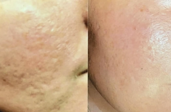 Collagen Induction Therapy - Dry skin tattooing or collagen induction therapy helps skin regrow collagen, reduce pore size, tighten skin, heal scars, acne marks, & gives skin a smoother younger look. Focus areas for smoothing scars, wrinkles, or acne marks can be combined with your treatment. For light spots, Melanocyte restoration is a new technique to help your skin restore its own color. Collagen Induction Therapy - Dry skin tattooing or collagen induction therapy helps skin regrow collagen, reduce pore size, tighten skin, heal scars, acne marks, & gives skin a smoother younger look. Focus areas for smoothing scars, wrinkles, or acne marks can be combined with your treatment. For light spots, Melanocyte restoration is a new technique to help your skin restore its own color.