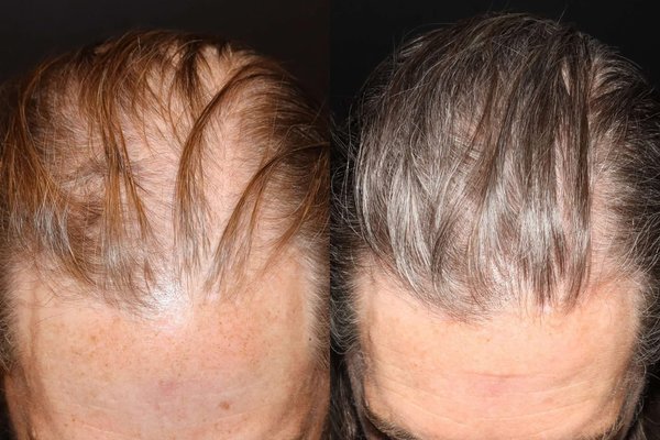 Hairlase Hair Restoration - Hair density & thickness - Looking for a way to increase your hair density and thickness?
Then Princeton Aesthetics HAIRestart® is exactly what you need.
HAIRestart® is an advanced, non-invasive laser treatment designed to stimulate hair growth and combat hair loss. Using the power of laser light, it activates dormant hair follicles, encouraging new hair growth in a safe and controlled way.
Why choose HAIRestart®?
· Prevents further hair loss
· Increases hair density & thickness
· No medication
· Minimal downtime
· Adjusted for different stages of alopecia
· Can be safely combined with other hair loss treatments
Choose Your Perfect Treatment. Choose Princeton Aesthetics! Hairlase Hair Restoration - Hair density & thickness - Looking for a way to increase your hair density and thickness?
Then Princeton Aesthetics HAIRestart® is exactly what you need.
HAIRestart® is an advanced, non-invasive laser treatment designed to stimulate hair growth and combat hair loss. Using the power of laser light, it activates dormant hair follicles, encouraging new hair growth in a safe and controlled way.
Why choose HAIRestart®?
· Prevents further hair loss
· Increases hair density & thickness
· No medication
· Minimal downtime
· Adjusted for different stages of alopecia
· Can be safely combined with other hair loss treatments
Choose Your Perfect Treatment. Choose Princeton Aesthetics!