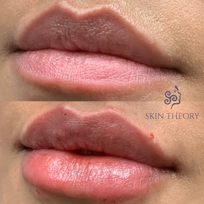 Lip Fillers Before and After - At Skin and Derm Theory, we believe in the power of natural-looking results. Our approach is rooted in the philosophy that beauty enhancements should highlight your intrinsic features, not overshadow them. This album showcases our commitment to creating beautifully plump lips that harmonize with each individual's unique facial structure, ensuring an outcome that feels as natural as it looks. Lip Fillers Before and After - At Skin and Derm Theory, we believe in the power of natural-looking results. Our approach is rooted in the philosophy that beauty enhancements should highlight your intrinsic features, not overshadow them. This album showcases our commitment to creating beautifully plump lips that harmonize with each individual's unique facial structure, ensuring an outcome that feels as natural as it looks.