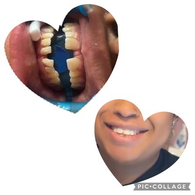 Let’s Enhance your smile today!! NOW ACCEPTING NEW CLIENTS - Have you ever considered enhancing Your beautiful smile?Are you looking for that beautiful hollywood smile that’s always camera ready?  
Here at Changing Smyles we offer that, and at an affordable price! 
 Come experience these wonderful services with exceptional quality care!
We also offer No credit check finance options that would assist with any payment needs.
Come visit a beautiful and peaceful atmosphere where you’re guaranteed able to enjoy your services. Same Day process, No pain, No drilling, No shaving of the real teeth at all.  

We Offer services such as Composite Veneers, Veneer Repairs, Chip teeth restoration, Gap Closures, and missing teeth building (upon consultation)